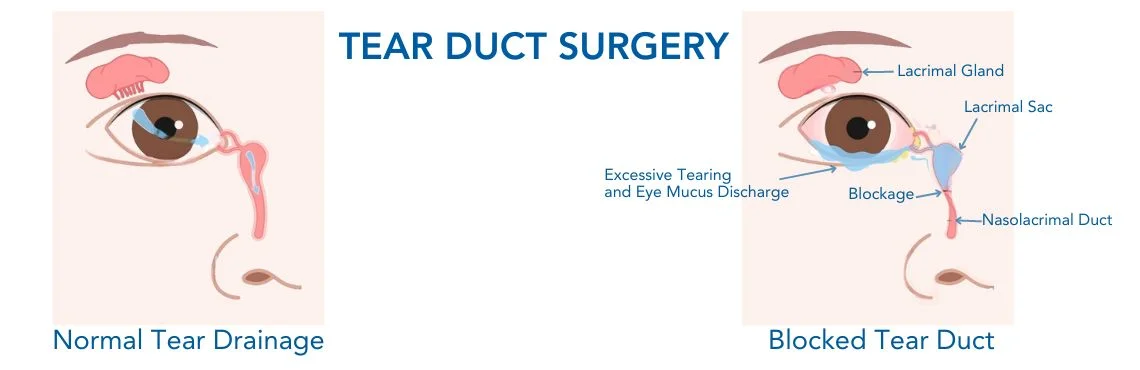 Tear Duct Surgery